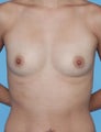Breast augmentation with Saline implants