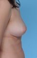Saline implants for breast augmentation