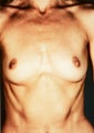 Breast Implants