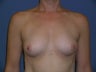 Breast Augmentation