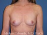Breast Augmentation 