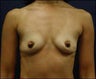 Breast Implants