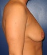 Breast Augmentation 