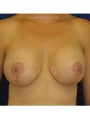  Bilateral mastopexy augmentation with placement of 397cc smooth silicone breast implants 