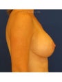  Bilateral mastopexy augmentation with placement of 397cc smooth silicone breast implants 