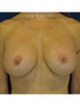 Bilateral Perioareolar Mastopexy with placement of subpectoral 659cc smooth silicone gel implants