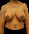 Breast Lift