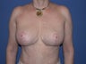 Before & After Mastopexy