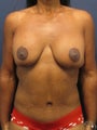 woman in her 40's who sustained weight loss, treated for breast deflation