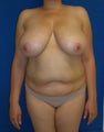 Breast Lift
