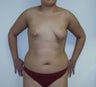 Correction of Tubular Breast and Assymetry