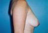 Breast Lift
