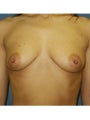 Bilateral mastopexy augmentation with placement of subpectoral 450cc smooth round saline breast implants instilled with 450cc bi
