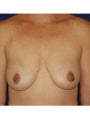  Bilateral mastopexy augmentation with placement of 397cc smooth silicone breast implants 