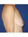  Bilateral mastopexy augmentation with placement of 397cc smooth silicone breast implants 