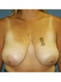  Bilateral mastopexy 