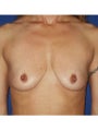 Bilateral Perioareolar Mastopexy with placement of subpectoral 659cc smooth silicone gel implants
