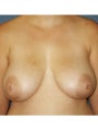 Bilateral Mastopexy