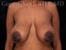 Breast Lift