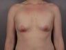 Breast Lift / Breast Augmentation  