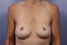 Breast Lift / Breast Augmentation 