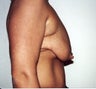 Breast Lift