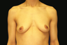 breast augmentation and mastopexy