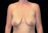 Breast Lift