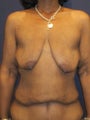 woman in her 40's who sustained weight loss, treated for breast deflation