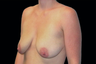 Breast Augmentation with mastoplexy