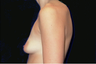 breast augmentation with lift