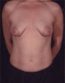 Breast Lift