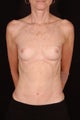 Breast Reconstruction