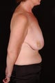 Breast Reconstruction and Reduction