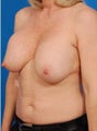 Breast Implant Revision