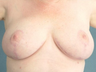 Breast Reduction/Breast Lift