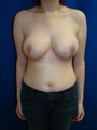 Breast Reduction