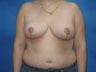 Breast Reduction