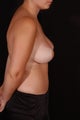 Breast Reduction and Lift