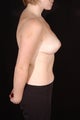 Breast Reduction
