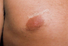 Male Breast reduction-Gynecomastia. Reduced size of nipples. 