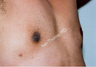 Male Breast reduction-Gynecomastia