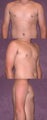 gynecomastia (mail breast reduction)