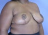 Breast Reduction