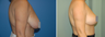 Breast Reduction