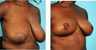 Breast Reduction