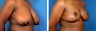 Breast Reduction