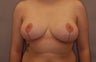 Breast Reduction