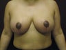 Breast Reduction