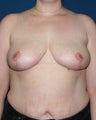 Breast Reduction